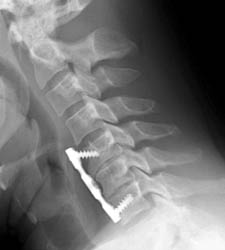 Lateral c-spine -Clik on the image to enlarge