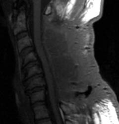 T1 Sagittal - Click on the image to enlarge