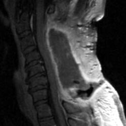 T1 Sagittal post contrast - Click on the image to enlarge