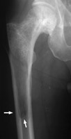 Right proxial femur - Click on the image for a larger version