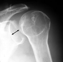 Shoulder posterior dislocation - Click on the image for a larger version